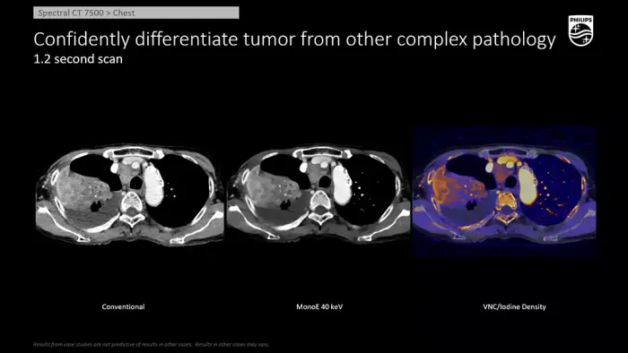 Philips Spectral CT 7500